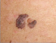 melanoma dermoscopia computerizzata